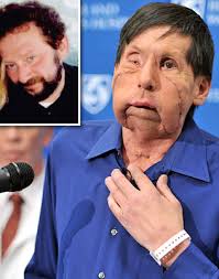 Face Transplants