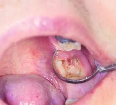 dry socket