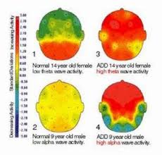 Boys are more affected by ADHD