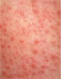 Thirteen cases of measles have