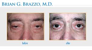 eyelid droop