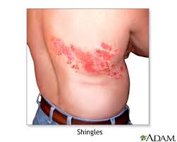 shingles virus