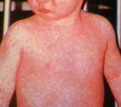 Measles