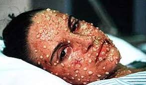 Smallpox 3