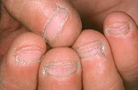 biting nails