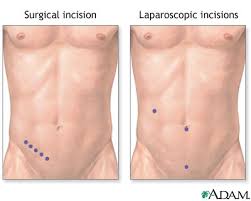 Appendectomy