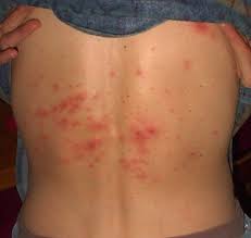 shingles virus