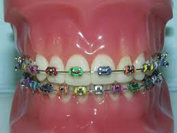 Why Do People Need Braces? metal braces Why Do People Need Braces?