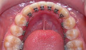 image lingual 3 Brackets   Aparato dental