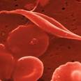 La <b>anemia hemolítica</b> es un