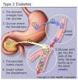 Diabetes: TYPE 2 DIABETES (non-insulin dependant diabetes) on ...