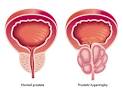 About Prostate Cancer | What is Prostate Cancer | Symptoms.