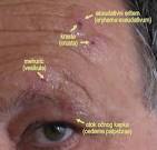 File:<b>Herpes zoster</b>