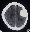 appearance of a <b>meningioma</b>