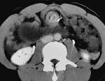 <b>Small bowel volvulus</b> secondary
