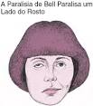 <b>Paralisia</b> de <b>Bell</b>