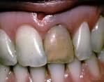 <b>Teeth</b> Whitening Procedures and Techniques | Causes of