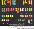 <b>Philadelphia Chromosome</b>
