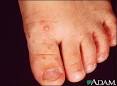 Hand, foot and <b>mouth disease</b>