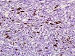 rhabdomyosarcoma-<b>desmin</b>