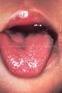 Rheumatology Image Bank : KAWASAKI DISEASE: Strawberry Tongue