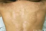 <b>Pityriasis Versicolor</b>