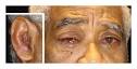 MEDICINA INTERNA: Varón de 59 Años con <b>Fiebre</b>, Dolor e Inflamación