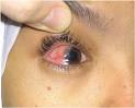 <b>Keratoconjunctivitis Sicca</b>