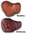 The symptoms of <b>cirrhosis</b> vary