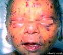 <b>Cytomegalovirus Infections</b>