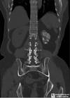 bifida; <b>Renal tuberculosis</b>