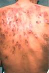 <b>Enfermedades</b> a la <b>piel</b> en