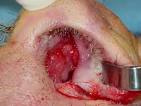 Cocaine use causes severe nasal damage | Drug Abuse & Drug Trafficking