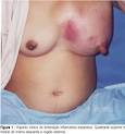 <b>Doença</b> de <b>paget mamária</b> www.lookfordiagnosis.com