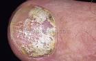 Subungual <b>Onychomycosis</b>