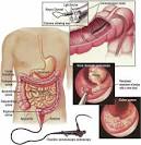 <b>colonoscopy</b>