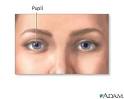 Scripps Health - <b>Anisocoria</b>