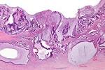 <b>mucinous adenocarcinoma</b>