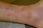 Superficial <b>thrombophlebitis</b>