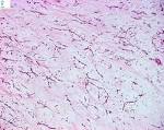 <b>Liposarcoma Mixoide</b>