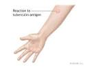 <b>Tuberculin</b> Skin Test