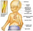 progeria Progeria : Aging