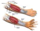 called <b>tennis elbow</b>,