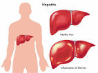 <b>Hepatitis</b> A B C D