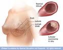 <b>Lobular carcinoma</b> in situ