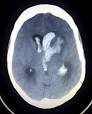 <b>intracranial hemorrhage</b>