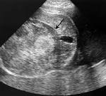 <b>Hepatoblastoma</b>.