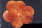 Fundus appearance of <b>retinitis</b>