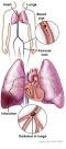 What is a pulmonary embolism?