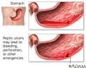 <b>Peptic ulcers</b> may lead to